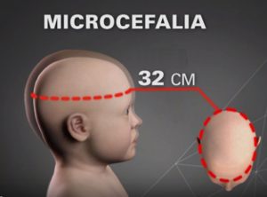 Microcefalia: Saiba mais sobre a Doença: Microcefalia é o comprometimento do desenvolvimento normal do cérebro levando a uma circunferência encefálica menor que a esperada para idade.