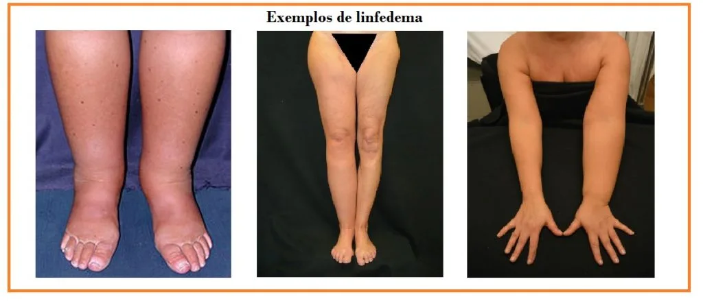 linfedema