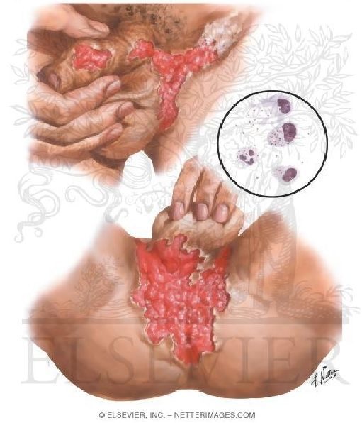 Granuloma Inguinal ou Donovanose