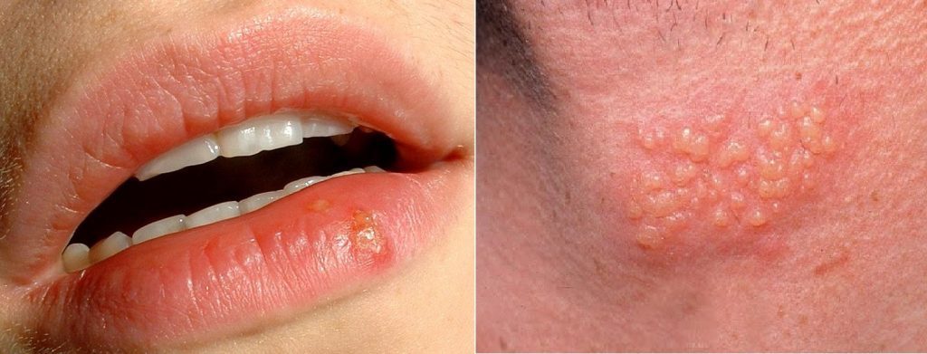 Vírus Herpes Simples Tipo 1 e 2