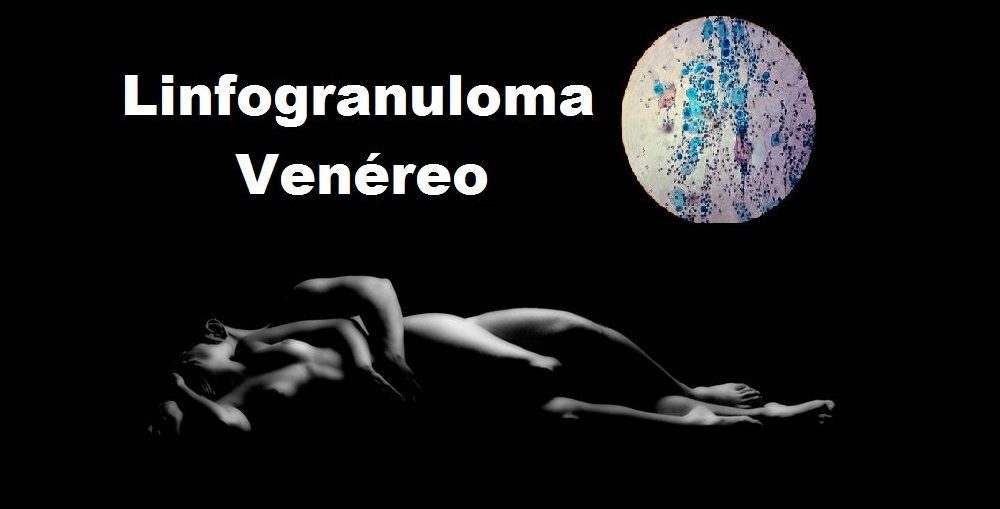 Infectologista - Linfogranuloma Venéreo: Conheça Infectologista - Linfogranuloma Venéreo: Conheça