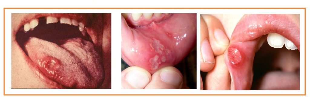 Cancro mole ou cancroide cancro-em-boca