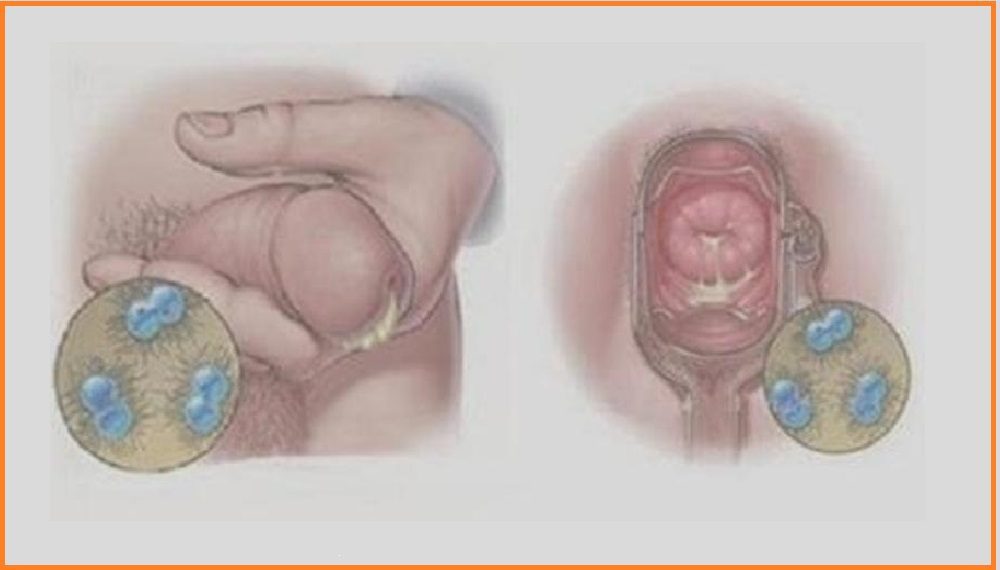 Infecções de Transmissão Sexual