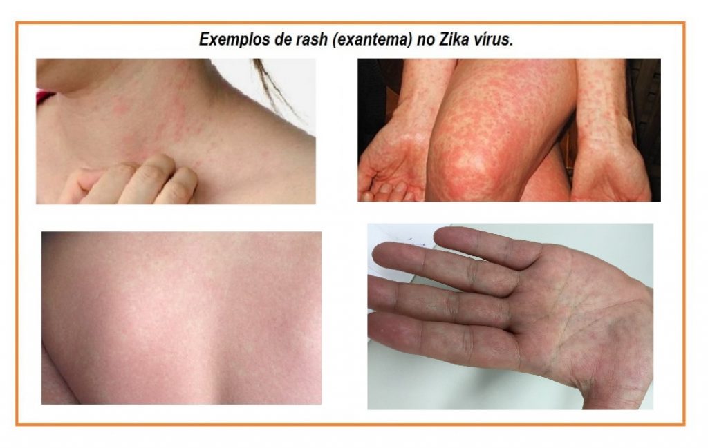 exantemano-zika-virus