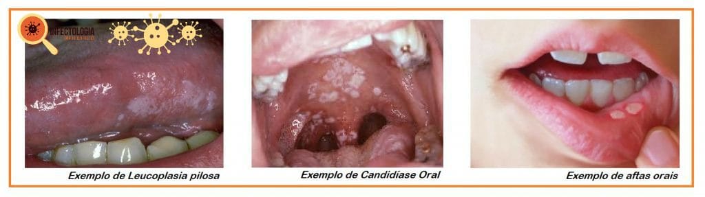 HIV: Saiba o que é a Síndrome Retroviral Aguda