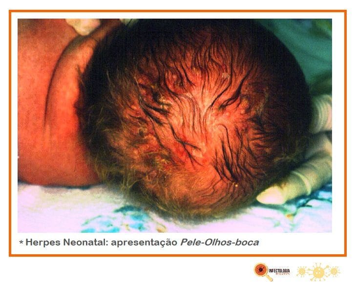 Herpes gestacional e herpes neonatal