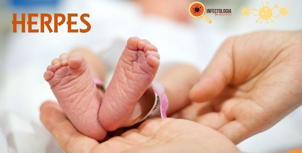 Infectologista - Herpes gestacional e herpes neonatal Infectologista - Herpes gestacional e herpes neonatal
