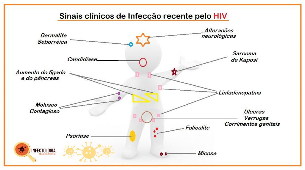 HIV: Saiba o que é a Síndrome Retroviral Aguda