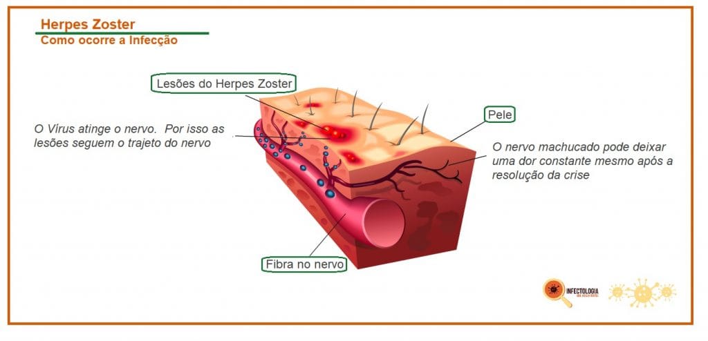 Herpes Zoster: Saiba mais