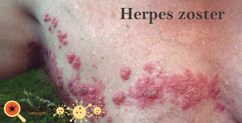 Herpes Zoster: Saiba mais