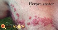 Herpes Zoster: Saiba mais