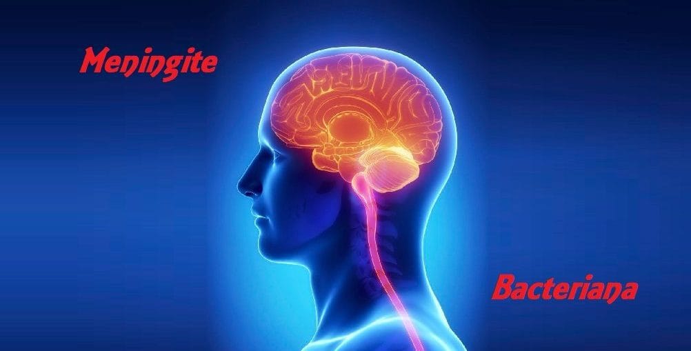 Infectologista - Meningite Bacteriana: O que Você Deve Saber Infectologista - Meningite Bacteriana: O que Você Deve Saber