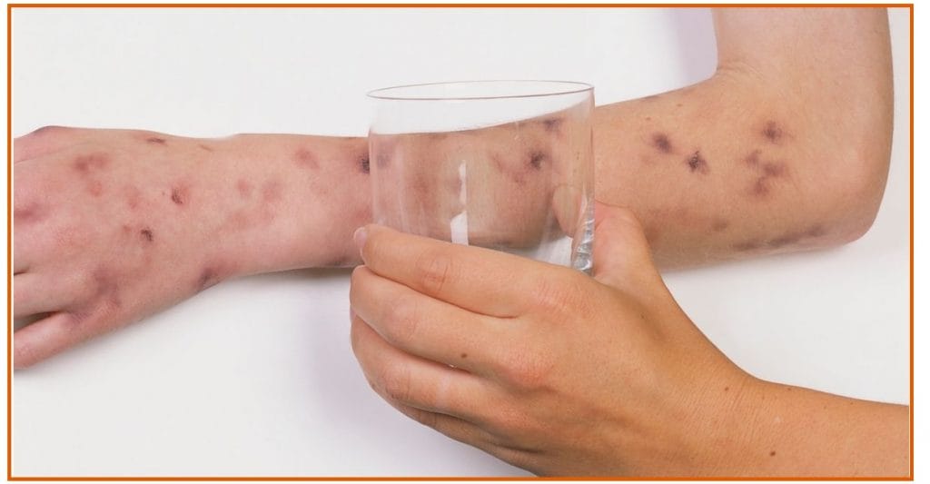 Meningite Bacteriana: o que você deve saber Meningite Bacteriana