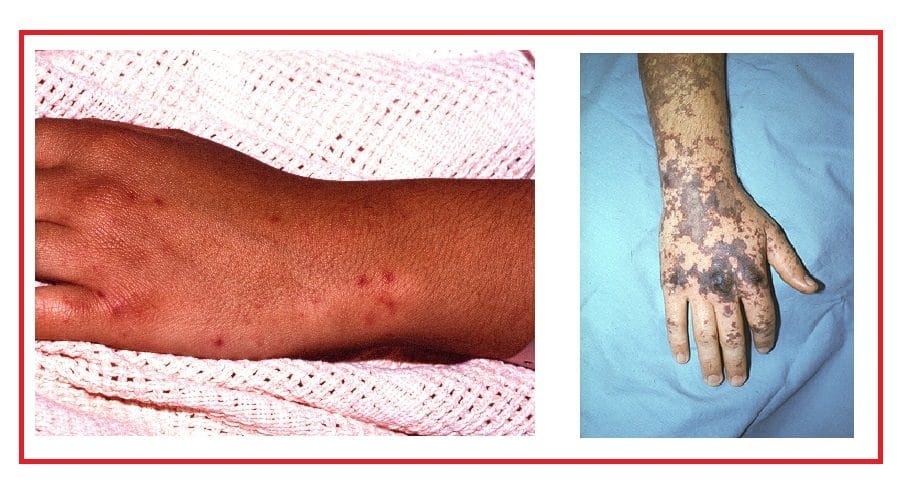 Infecção Meningocócica - Saiba Mais