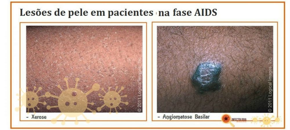 Sintomas da AIDS