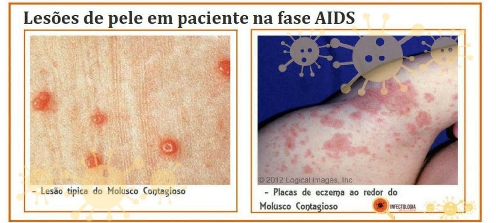 Sintomas da AIDS