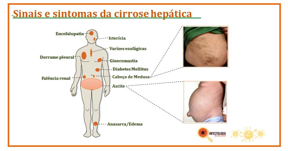 Cirrose hepática é a fase irreversível da lesão hepática.