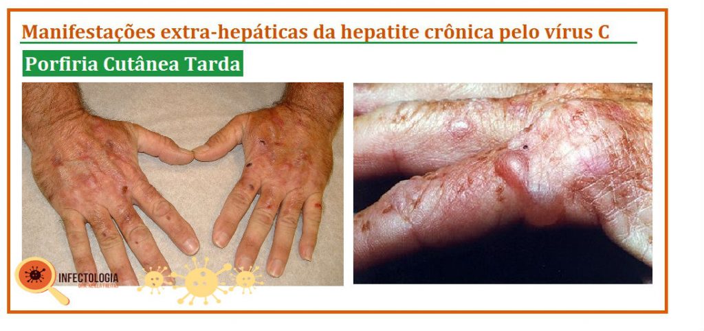 Hepatite C: o que você precisa saber