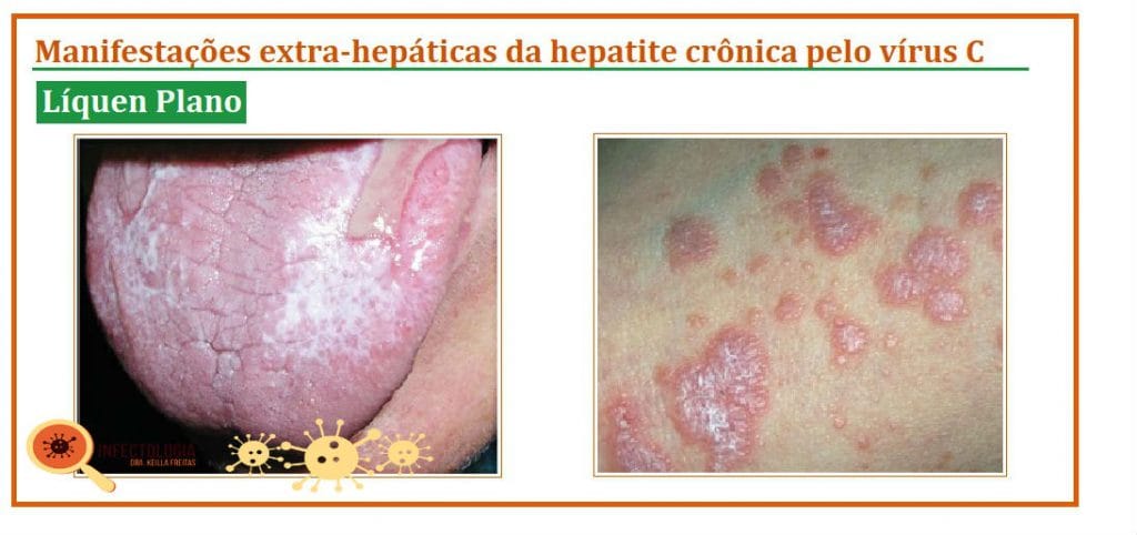 Hepatite C: o que você precisa saber