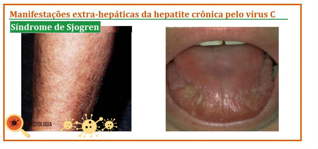 Hepatite C: o que você precisa saber