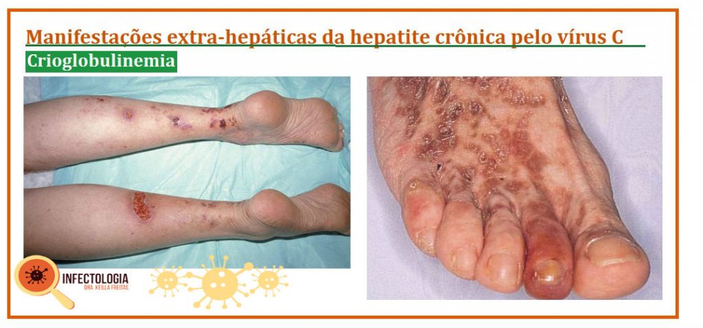 Hepatite C: o que você precisa saber