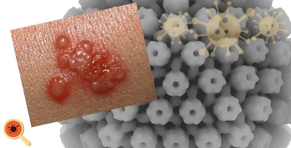 Infectologista - Manifestações do vírus da Herpes Infectologista - Manifestações do vírus da Herpes