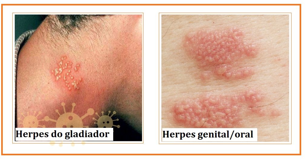 Manifestacoes Do Virus Da Herpes Dra Keilla Freitas