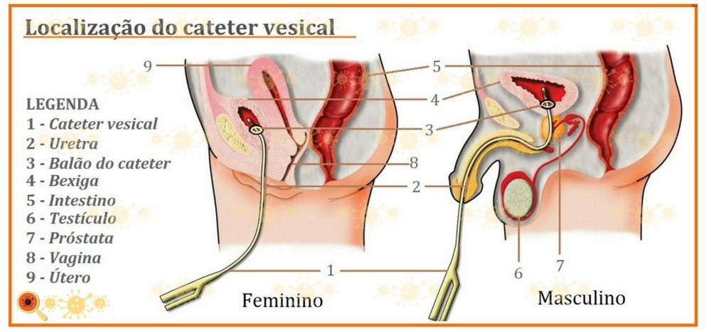 Infecção urinaria e cateter vesical