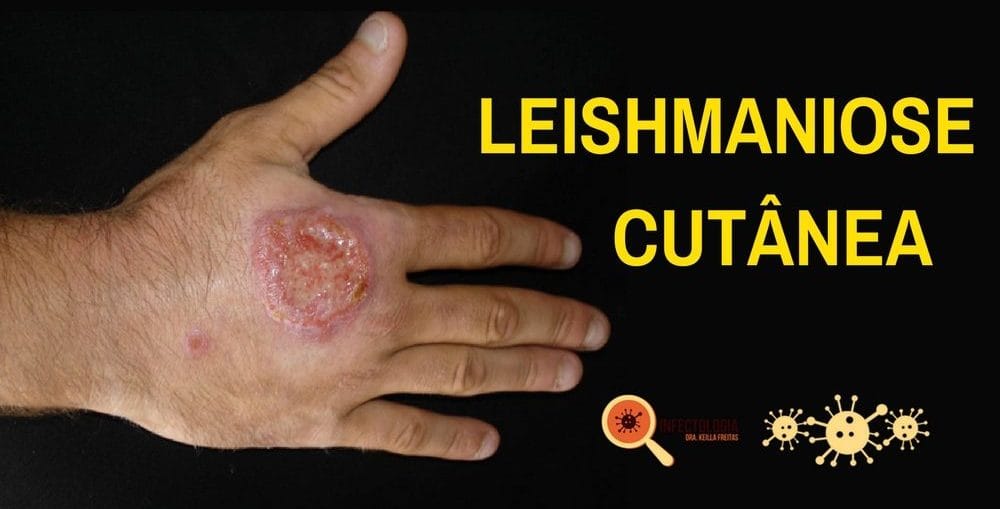 Infectologista - Leishmaniose Cutânea Infectologista - Leishmaniose Cutânea