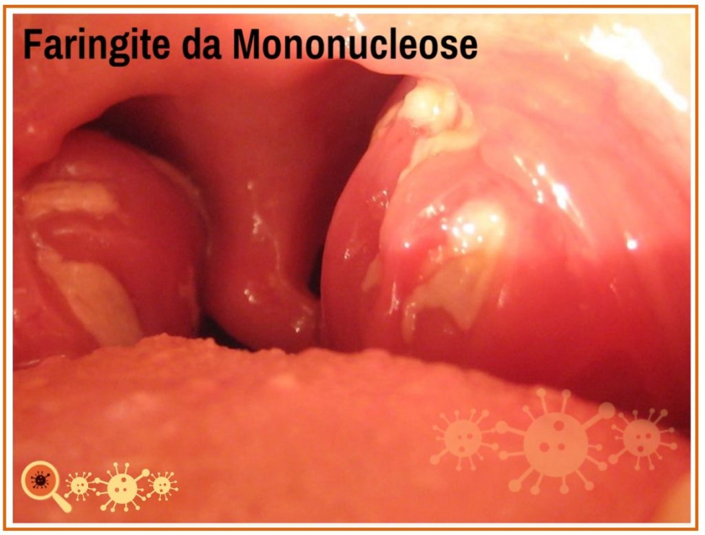 Mononucleose - conheça