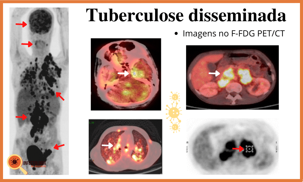 Tuberculose disseminada