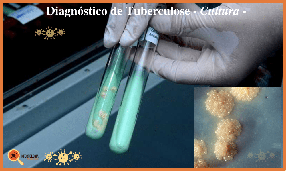 Diagnóstico da Tuberculose