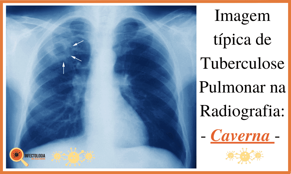 Sintomas da Tuberculose