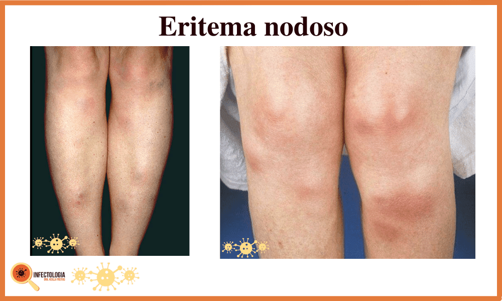 Sintomas da Tuberculose