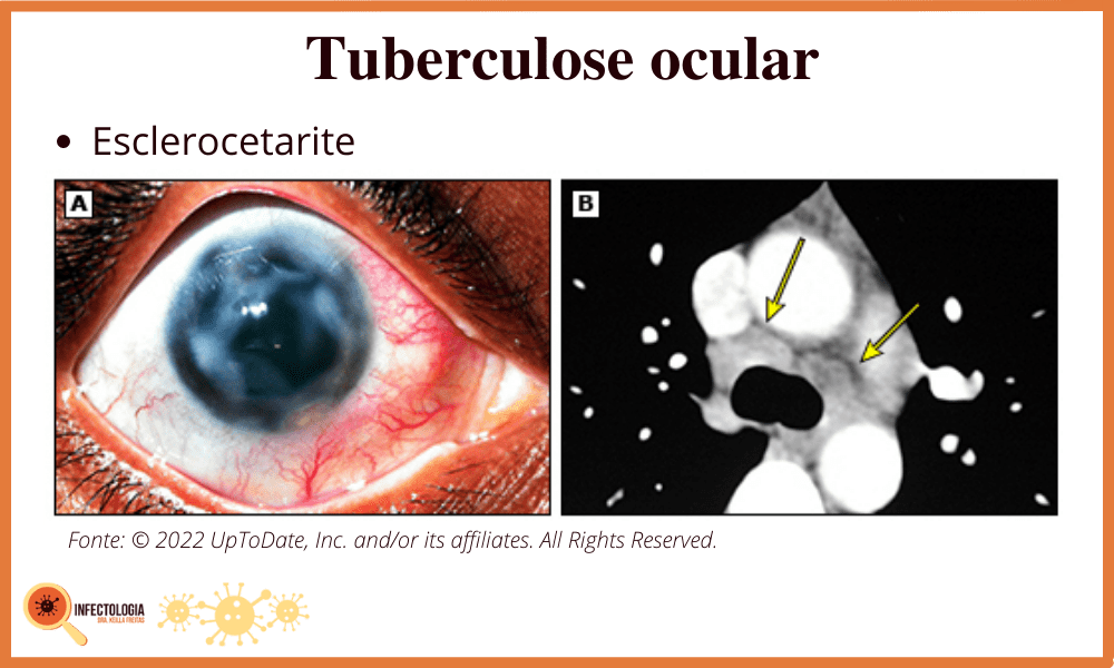 Sintomas da Tuberculose