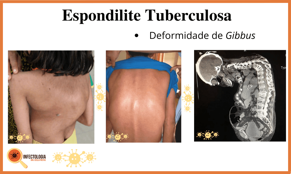 Sintomas da Tuberculose