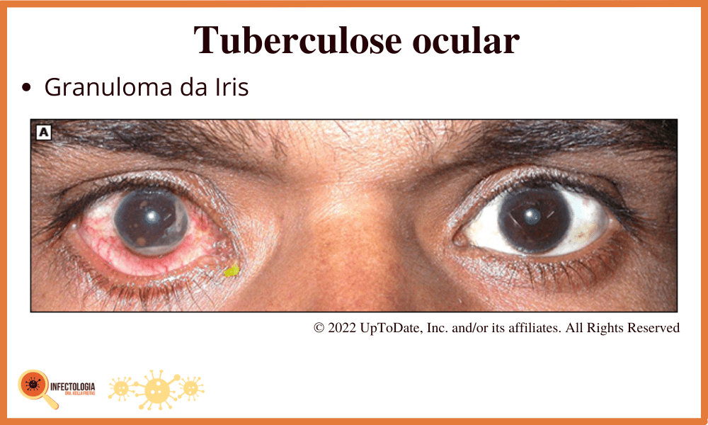 Sintomas da Tuberculose