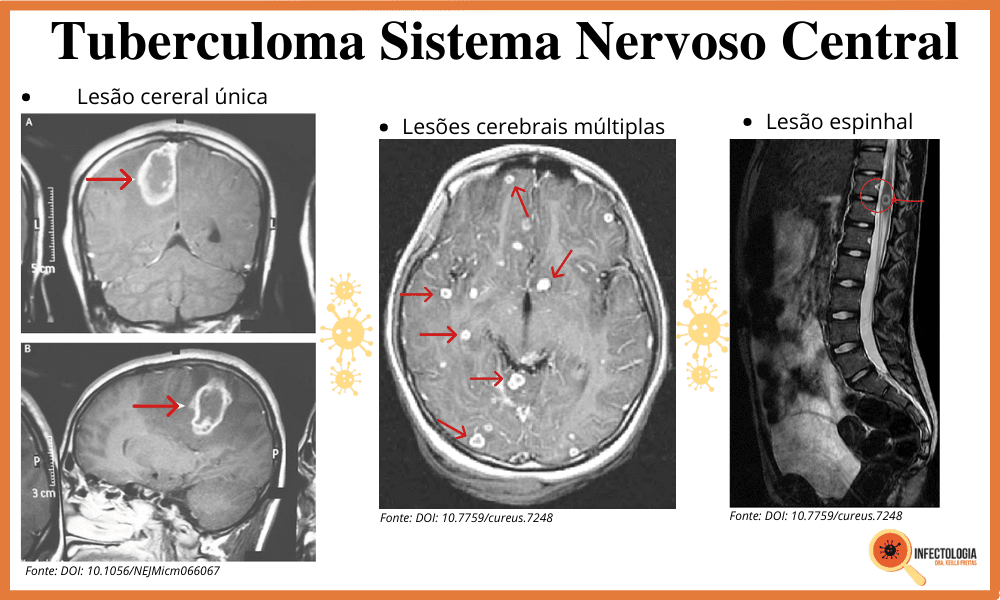 Tuberculoma