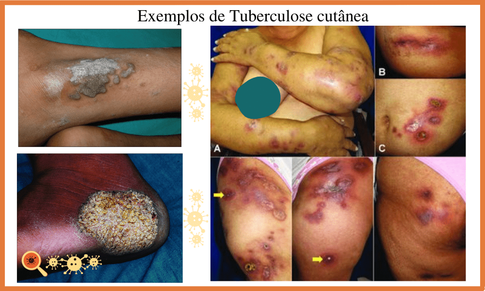 Sintomas da Tuberculose