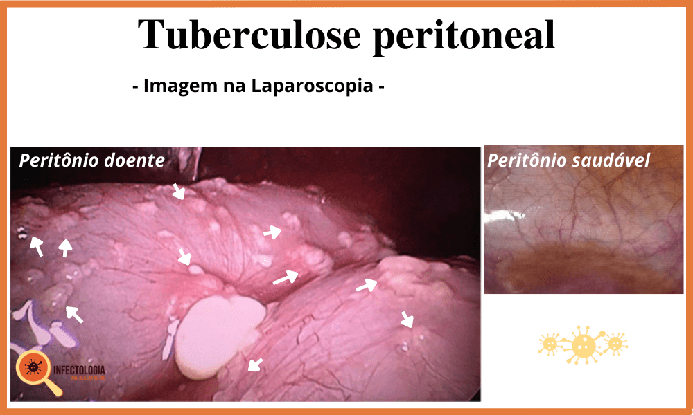 Sintomas da Tuberculose