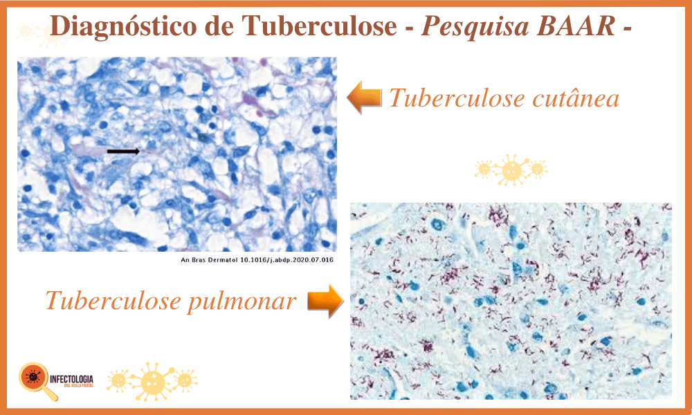 Diagnóstico da Tuberculose