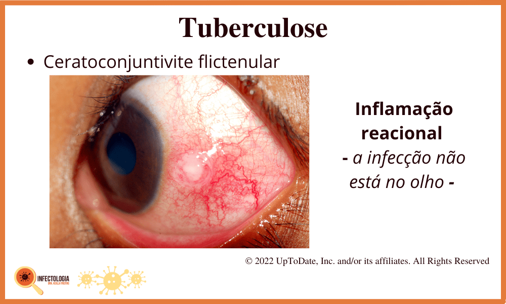 Sintomas da Tuberculose