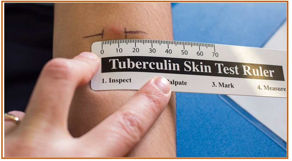 Diagnóstico de Tuberculose