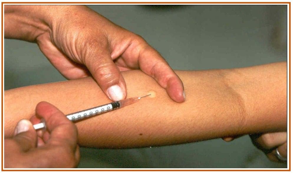 diagnóstico da tuberculose diagnóstico da tuberculose
