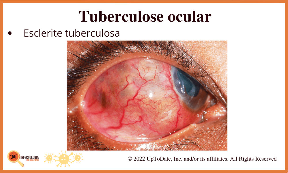 Sintomas da Tuberculose