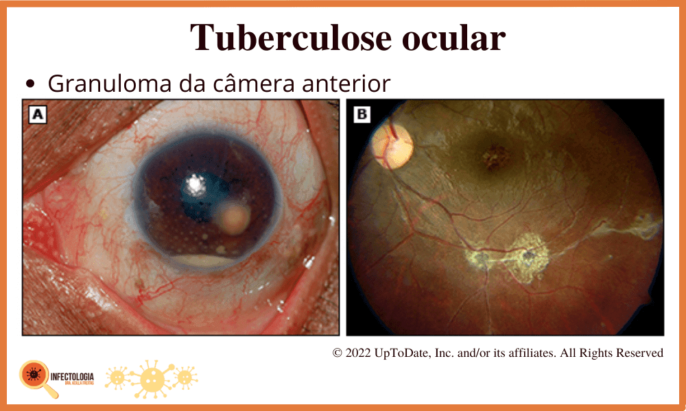 Sintomas da Tuberculose