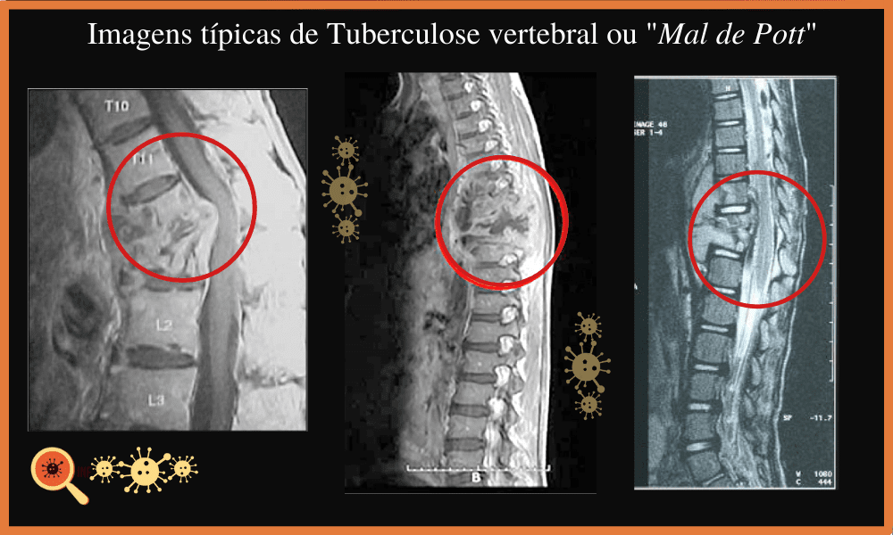 Sintomas da Tuberculose