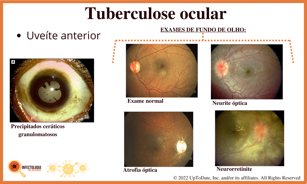 Sintomas da Tuberculose