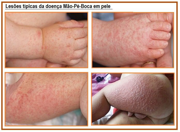 Doença Mão Pé Boca Doença Mão Pé Boca