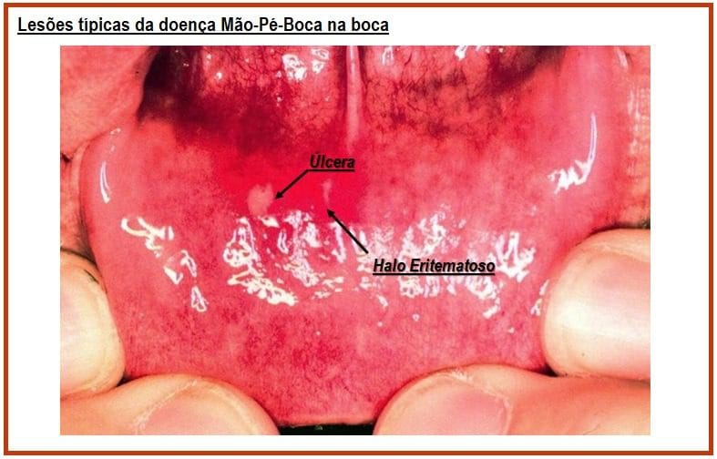 Doença Mão Pé Boca